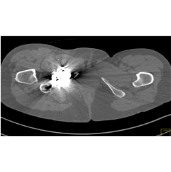 Recurrent Pelvic Arteriovenous Malformation (AVM) S/p Embolization - CTisus CT Scan