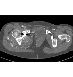 Recurrent Pelvic Arteriovenous Malformation (AVM) S/p Embolization - CTisus CT Scan