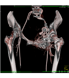 Recurrent Pelvic Arteriovenous Malformation (AVM) S/p Embolization - CTisus CT Scan