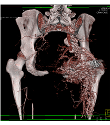 Recurrent Pelvic Arteriovenous Malformation (AVM) S/p Embolization - CTisus CT Scan