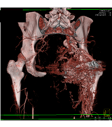 Recurrent Pelvic Arteriovenous Malformation (AVM) S/p Embolization - CTisus CT Scan