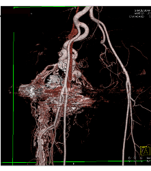 Recurrent Pelvic Arteriovenous Malformation (AVM) S/p Embolization - CTisus CT Scan