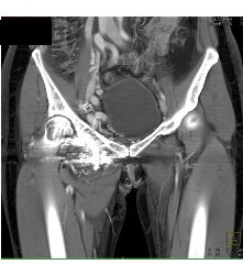 Recurrent Pelvic Arteriovenous Malformation (AVM) S/p Embolization - CTisus CT Scan