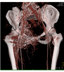 Recurrent Pelvic Arteriovenous Malformation (AVM) S/p Embolization - CTisus CT Scan