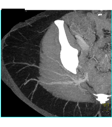 Sgap Planning - CTisus CT Scan