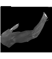 CTA S/p Trauma Without Bleed - CTisus CT Scan