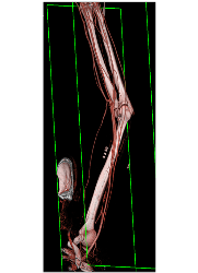 CTA S/p Trauma Without Bleed - CTisus CT Scan