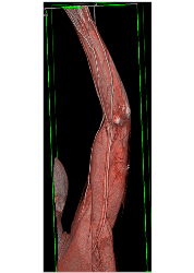 CTA S/p Trauma Without Bleed - CTisus CT Scan