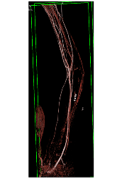 CTA S/p Trauma Without Bleed - CTisus CT Scan