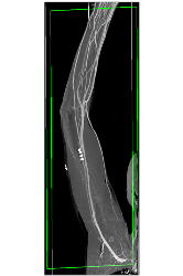 CTA S/p Trauma Without Bleed - CTisus CT Scan