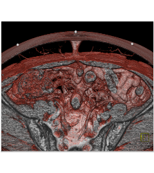 DIEP Planning for Breast Reconstruction - CTisus CT Scan