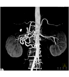 Celiac Stenosis With Dilated Gastroduodenal Artery (GDA)- Classic! - CTisus CT Scan