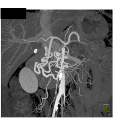 Celiac Stenosis With Dilated Gastroduodenal Artery (GDA)- Classic! - CTisus CT Scan