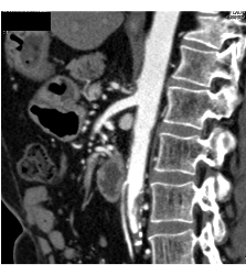 Celiac Stenosis With Dilated Gastroduodenal Artery (GDA)- Classic! - CTisus CT Scan