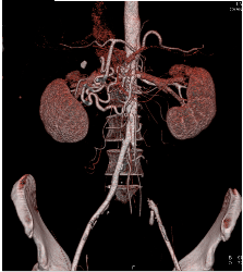 Celiac Stenosis With Dilated Gastroduodenal Artery (GDA)- Classic! - CTisus CT Scan