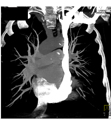 Left SVC - CTisus CT Scan