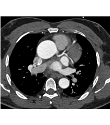 Dilated Aortic Root Without Dissection - CTisus CT Scan