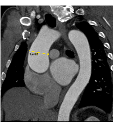 Dilated Aortic Root Without Dissection - CTisus CT Scan