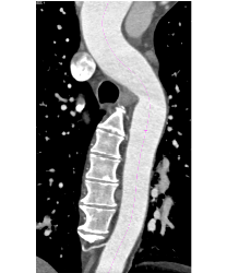 Dilated Aortic Root Without Dissection - CTisus CT Scan