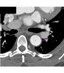 Dilated Aortic Root Without Dissection - CTisus CT Scan