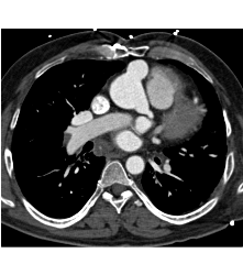 Pseudoaneurysm Off the Aorta - CTisus CT Scan