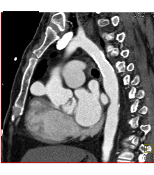 Pseudoaneurysm Off the Aorta - CTisus CT Scan