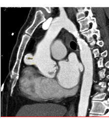 Pseudoaneurysm Off the Aorta - CTisus CT Scan