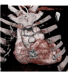 Pseudoaneurysm Off the Aorta - CTisus CT Scan