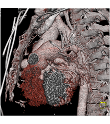 Pseudoaneurysm Off the Aorta - CTisus CT Scan