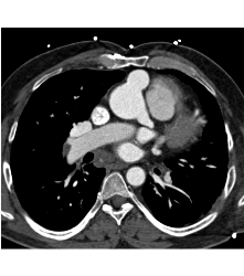 Pseudoaneurysm Off the Aorta - CTisus CT Scan