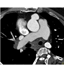 Pseudoaneurysm Off the Aorta - CTisus CT Scan