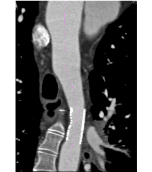 Endovascular Stent Also Seen - CTisus CT Scan