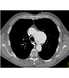 Focal Dissection and Aneurysm in Arch - CTisus CT Scan