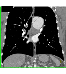 Focal Dissection and Aneurysm in Arch - CTisus CT Scan