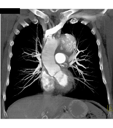 Focal Dissection and Aneurysm in Arch - CTisus CT Scan