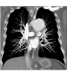 Focal Dissection and Aneurysm in Arch - CTisus CT Scan