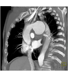 Focal Dissection and Aneurysm in Arch - CTisus CT Scan