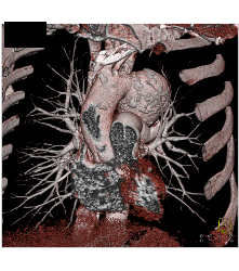 Focal Dissection and Aneurysm in Arch - CTisus CT Scan