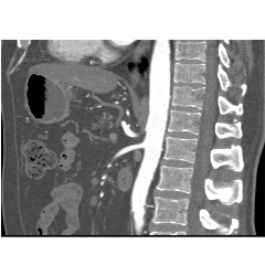 Median Arcuate Ligament Syndrome - CTisus CT Scan