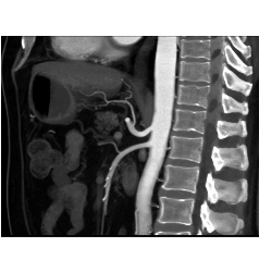 Normal Celiac/SMA - CTisus CT Scan