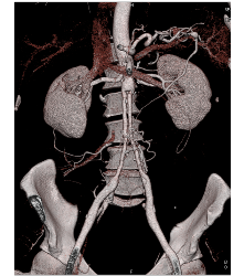 Ehlers-Danlos Syndrome S/p Repair - CTisus CT Scan