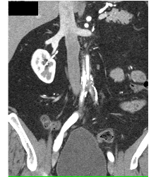 Ehlers-Danlos Syndrome S/p Repair - CTisus CT Scan