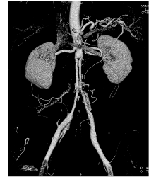 Ehlers-Danlos Syndrome S/p Repair - Vascular Case Studies - CTisus CT ...