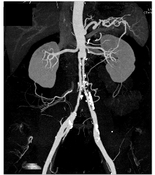 Ehlers-Danlos Syndrome S/p Repair - CTisus CT Scan