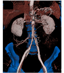 Ehlers-Danlos Syndrome S/p Repair - CTisus CT Scan