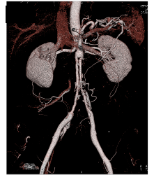 Ehlers-Danlos Syndrome S/p Repair - CTisus CT Scan