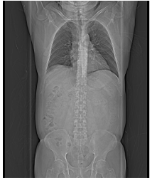 Excellent Contrast Throughout Aorta With Subsecond Flash Acquisition and Bolus Triggering - CTisus CT Scan