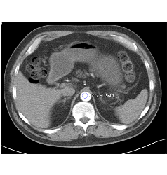 Excellent Contrast Throughout Aorta With Subsecond Flash Acquisition and Bolus Triggering - CTisus CT Scan