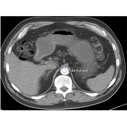 Excellent Contrast Throughout Aorta With Subsecond Flash Acquisition and Bolus Triggering - CTisus CT Scan