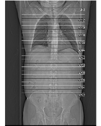 Excellent Contrast Throughout Aorta With Subsecond Flash Acquisition and Bolus Triggering - CTisus CT Scan